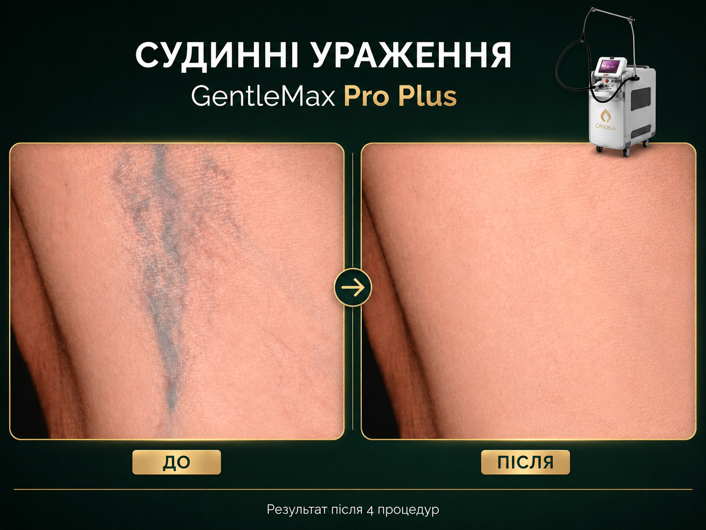 GentleMax Pro Plus - Фото 5