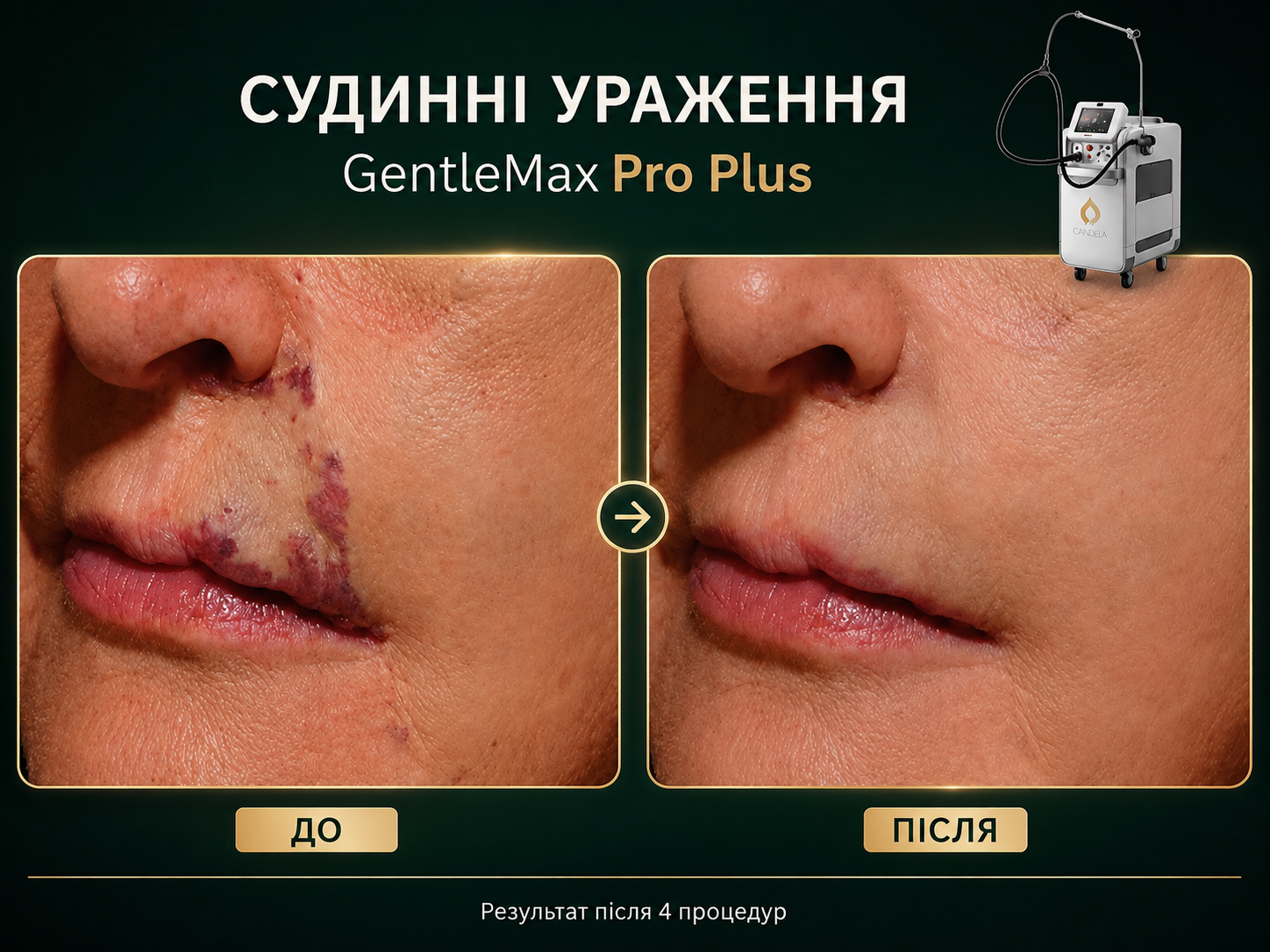GentleMax Pro Plus - Фото 6